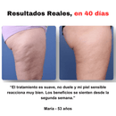 ¡Última oportunidad! Esta oferta expira en 2 horas - SmoothGlow™ - Masajeador anticelulítico